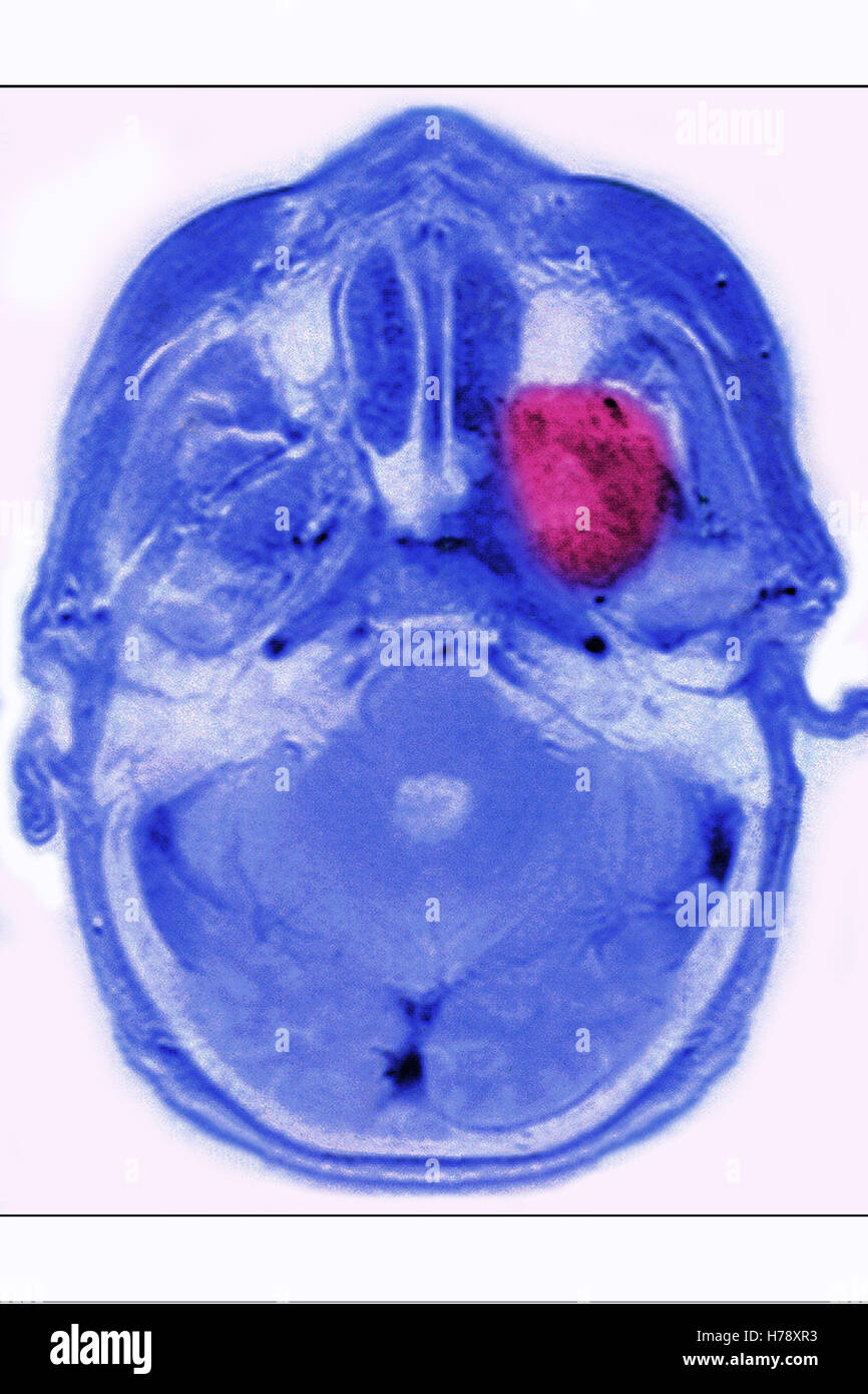 NEURINOME IRM Banque D'Images
