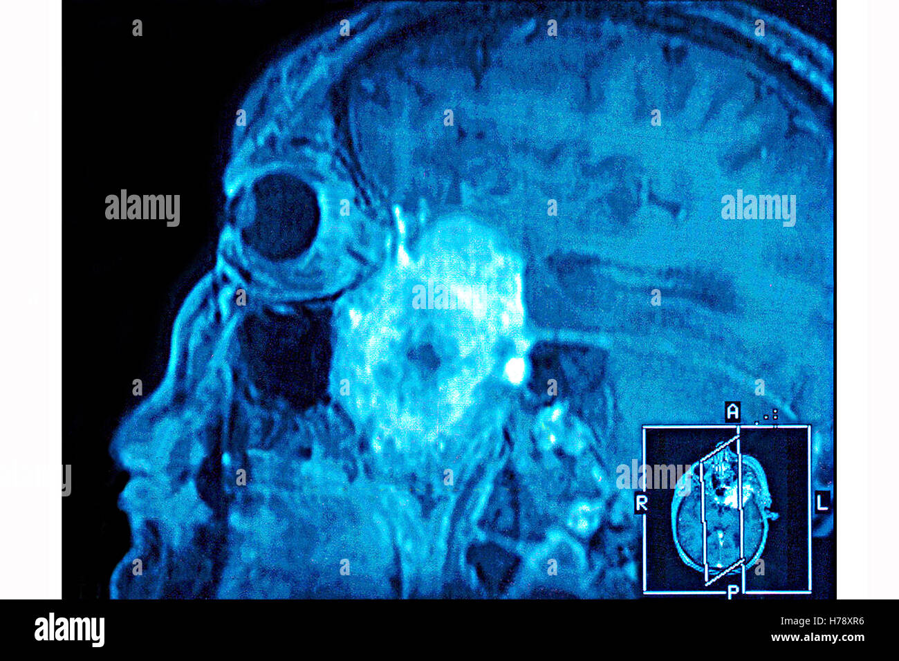 NEURINOME IRM Banque D'Images