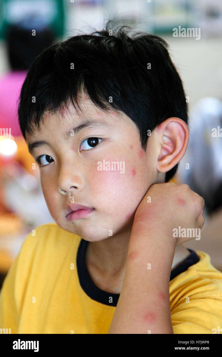 Piqure De Moustique Banque D Image Et Photos Alamy Piqure De Moustique Banque D Image Et Photos Alamy