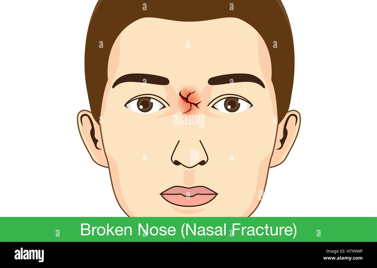 Fracture du nez sur le visage de l'homme. Illustration de Vecteur