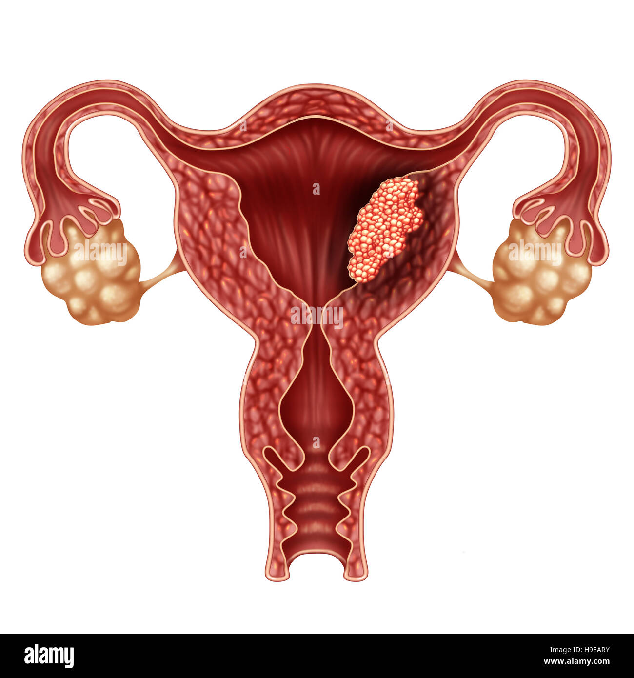 Cancer of the uterus Banque de photographies et d'images à haute ...