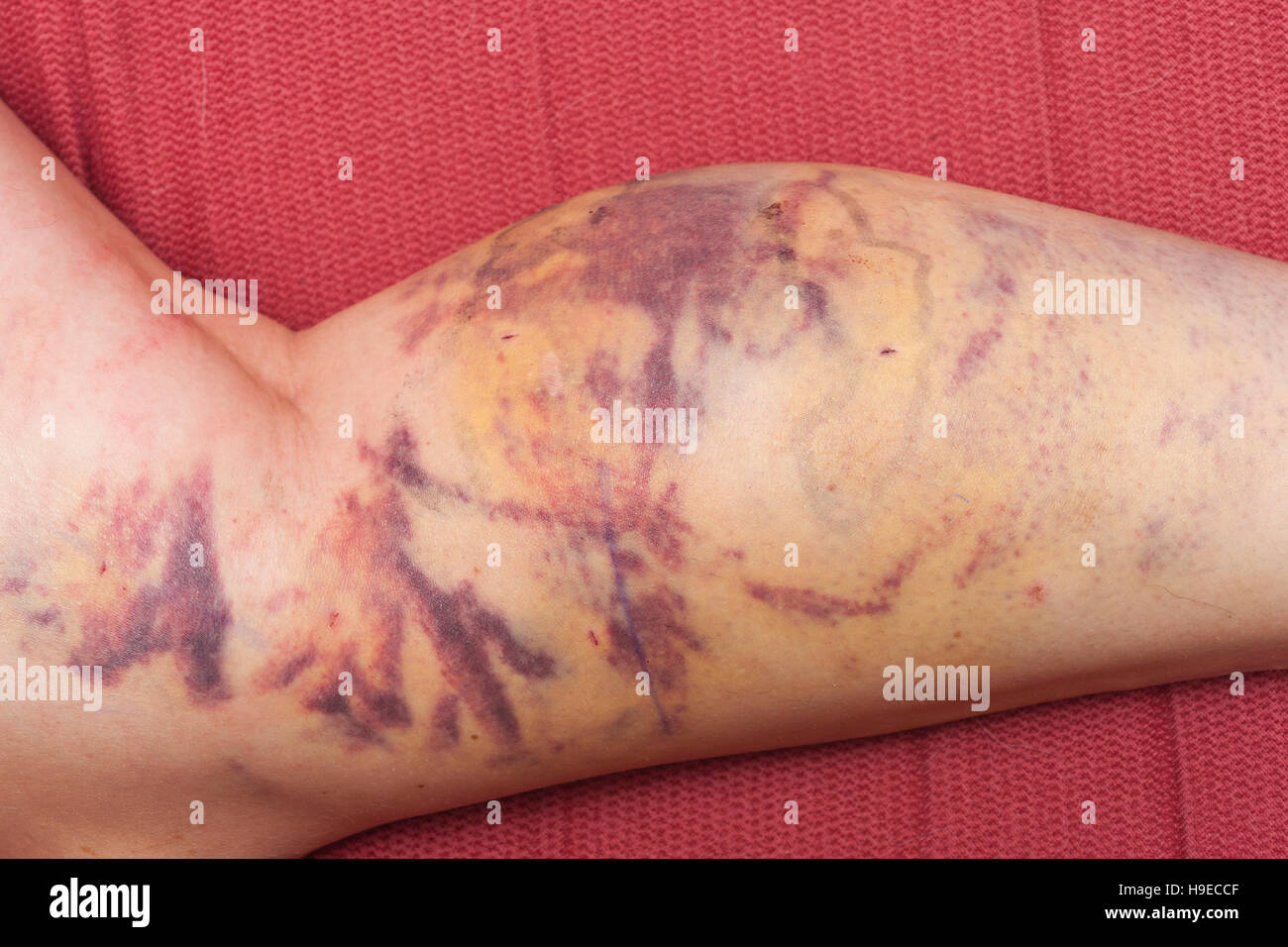 Des bleus sur la jambe d'une femme après avoir retiré des varices par laser dans le Royaume-Uni Banque D'Images