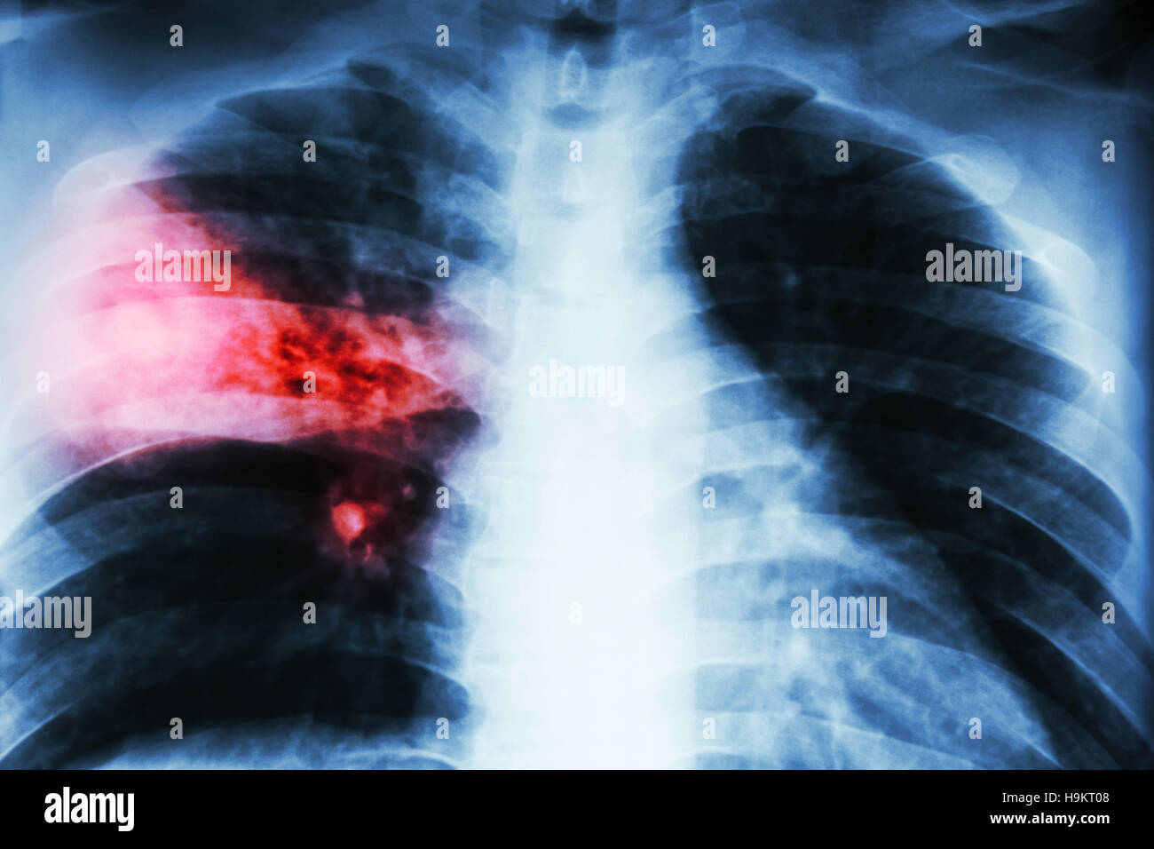 La pneumonie lobaire . film radiographie de montrer l'infiltration alvéolaire du lobe moyen droit dû à la tuberculose infection . Banque D'Images