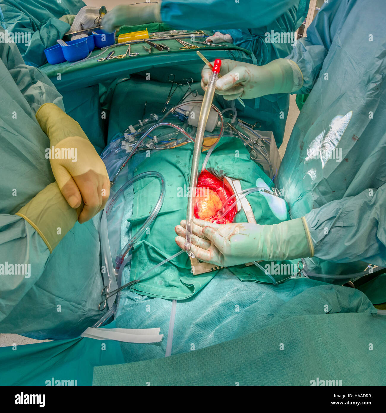 Chirurgie de remplacement de valve cardiaque, salle d'opération, Reykjavik, Islande Banque D'Images