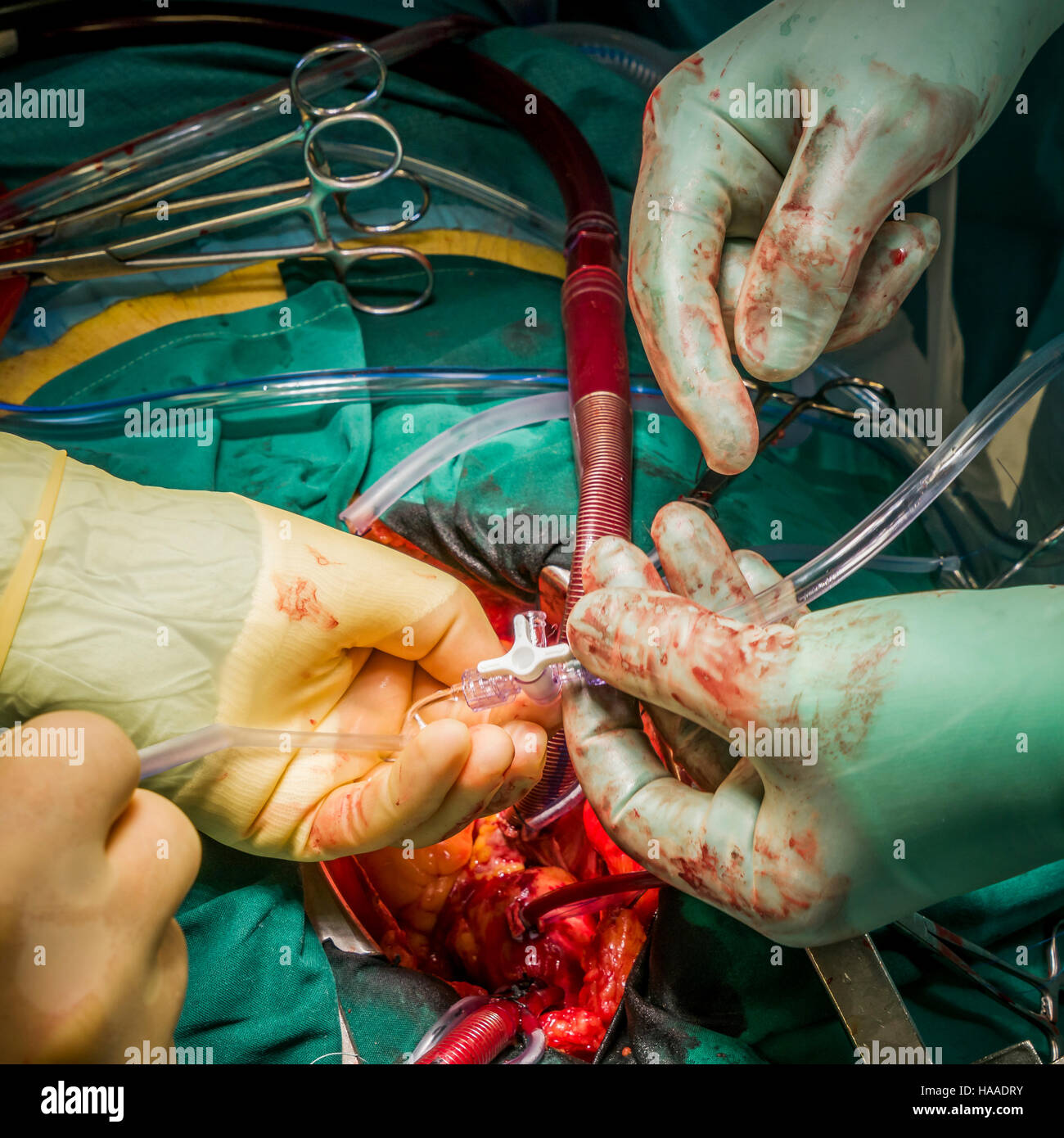 Chirurgie de remplacement de valve cardiaque, salle d'opération, Reykjavik, Islande Banque D'Images