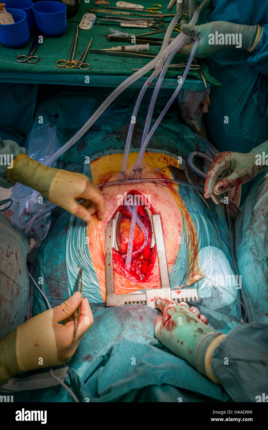 Chirurgie de remplacement de valve cardiaque, salle d'opération, Reykjavik, Islande Banque D'Images