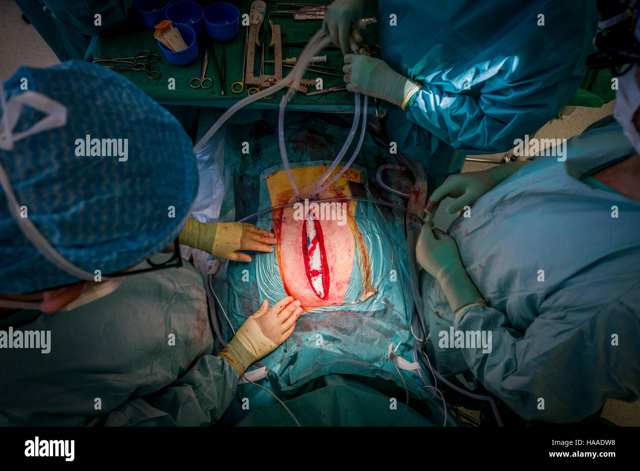 Chirurgie de remplacement de valve cardiaque, salle d'opération, Reykjavik, Islande Banque D'Images