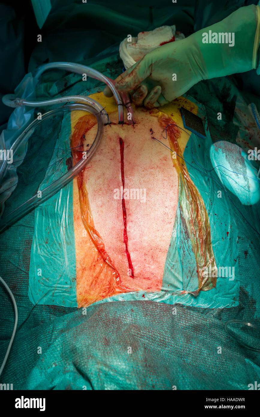 Chirurgie de remplacement de valve cardiaque, salle d'opération, Reykjavik, Islande Banque D'Images