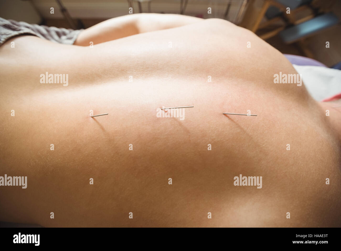 Patient qui aiguille sèche à l'arrière Banque D'Images