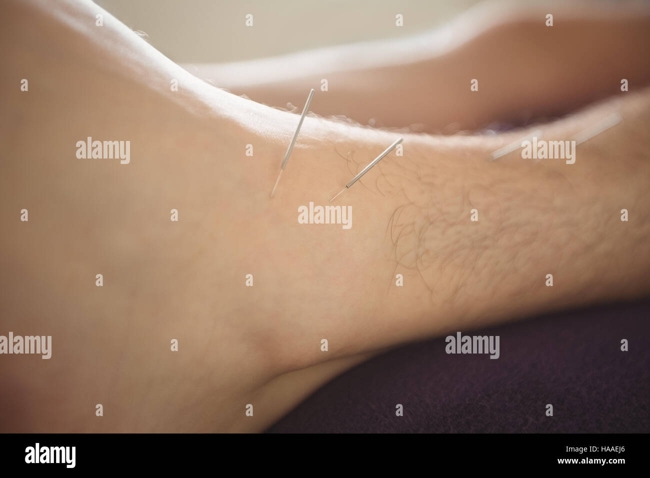 Patient qui aiguille sèche sur leg Banque D'Images