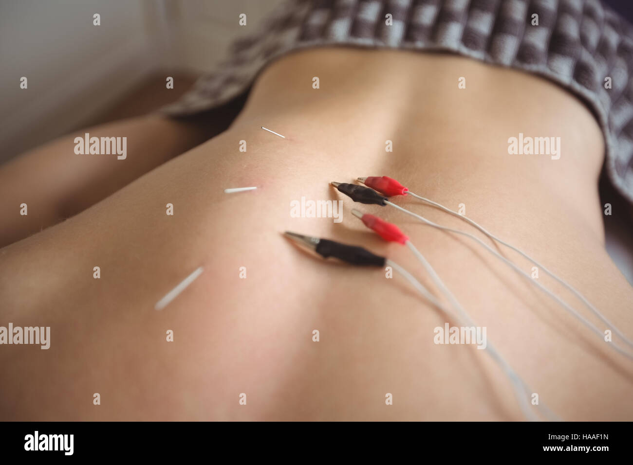 Mid section d'un patient qui l'électro aiguille sèche sur son dos Banque D'Images