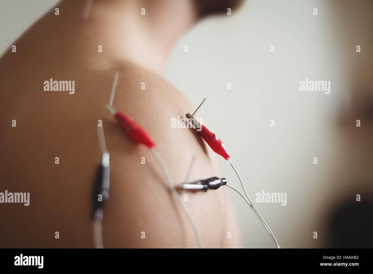 Close-up of patient qui aiguille sèche électro Banque D'Images