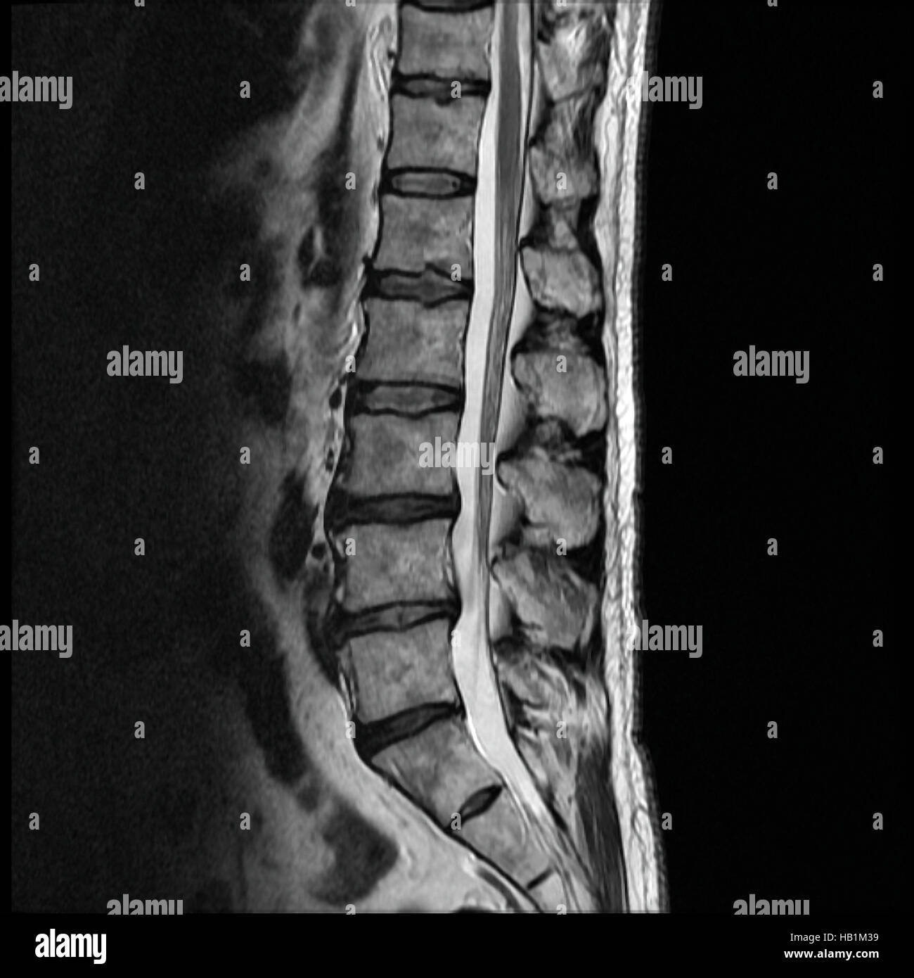 L'IRM d'un Lumbar-Disk Hernie Banque D'Images