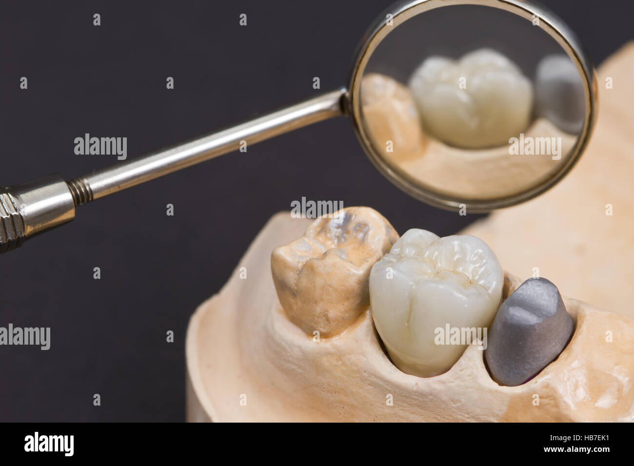 Libre pour une couronne dentaire en céramique pour une molaires sur un modèle de distribution Banque D'Images