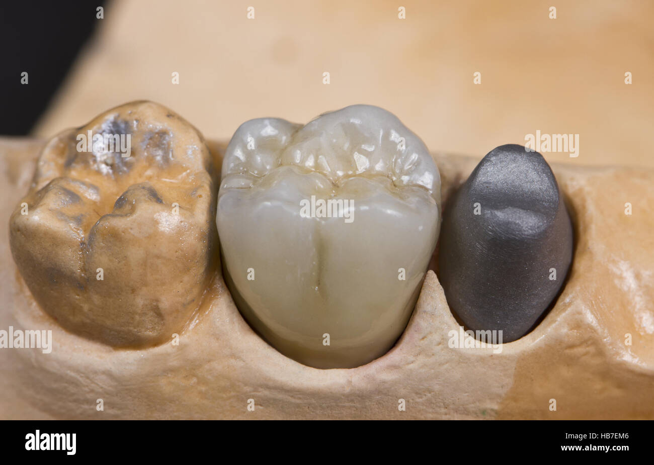Libre pour une couronne dentaire en céramique pour une molaires sur un modèle de distribution Banque D'Images