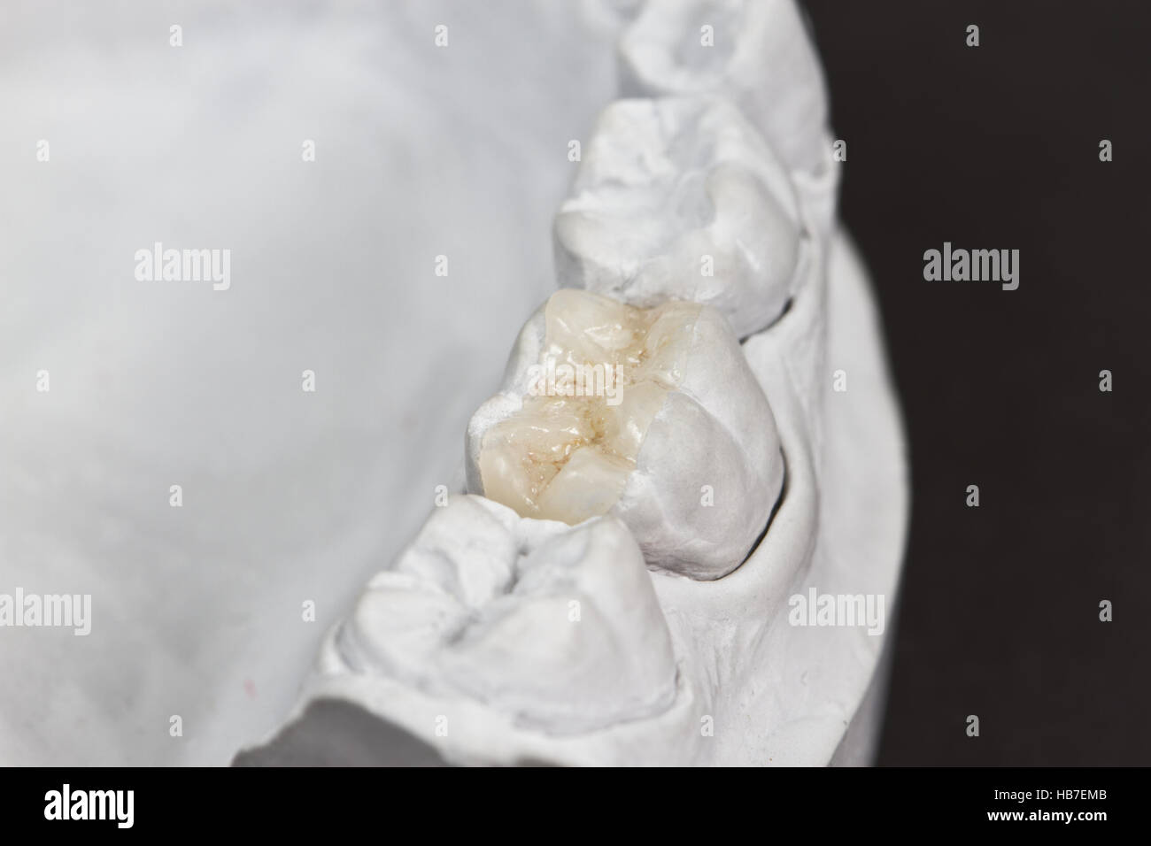 Libre pour les soins dentaires d'onlay sur une molaire est indiqué sur un modèle en plâtre Banque D'Images