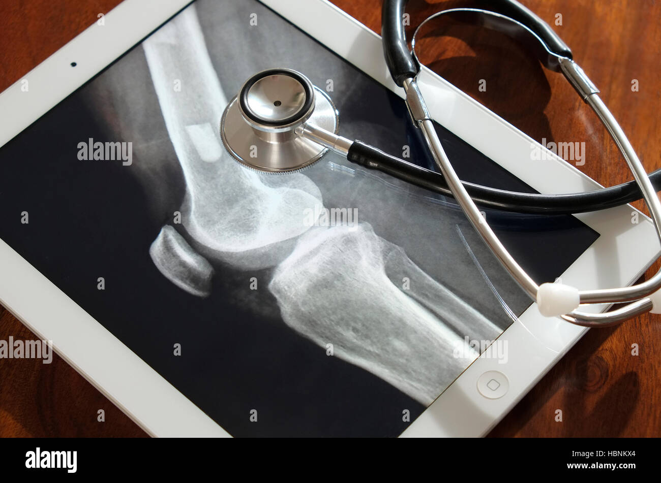 X-ray image sur tablette ipad moniteur écran de fémur jambe Banque D'Images