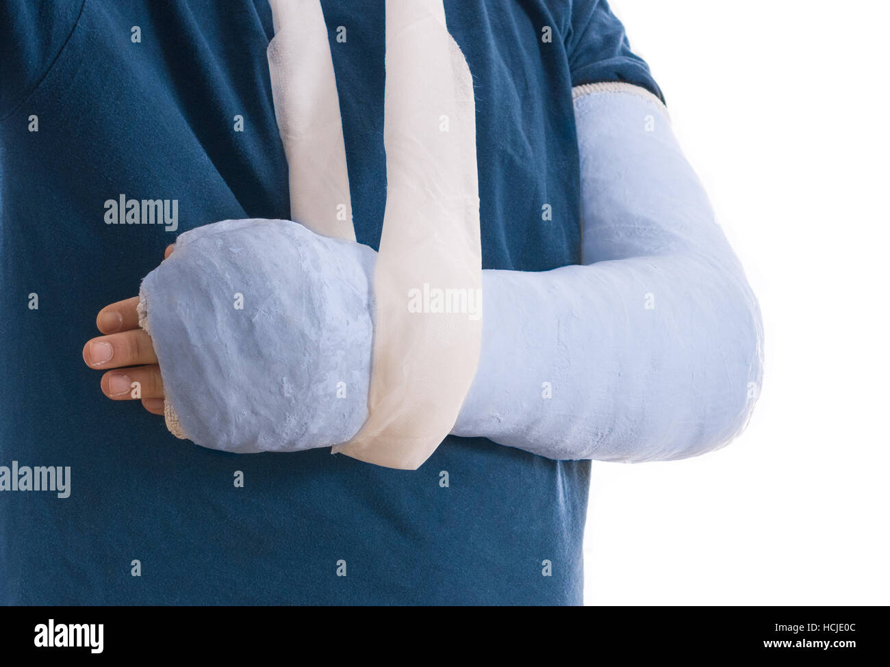 Cast - bras bras bleu bleu vif exprimés dans une écharpe pour un coude, le  bras cassé,
