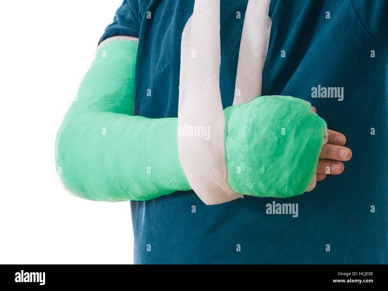 Vert vif - moulage du bras bras long cast dans une écharpe pour un coude,  le bras cassé, ou le poignet. Couverts en plâtre du bras / plâtre / fibre  de verre.