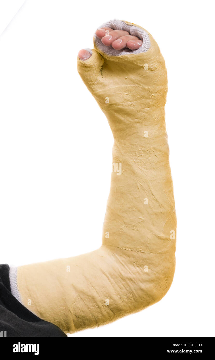 Close up of a young man's long bras jaune / plâtre plâtre en fibre de verre  couvrant le poignet, le bras, et le coude après un accident, isolated on  white Photo Stock -