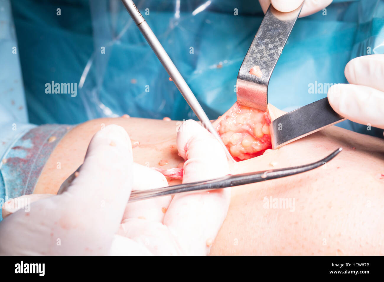 Opération chirurgicale l'arthroscopie du genou chirurgie micro sur ...