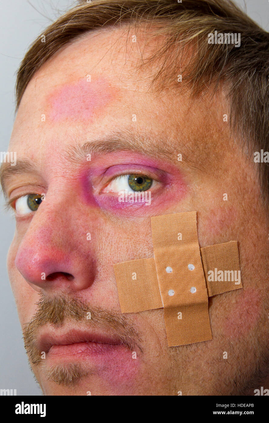 Homme avec des défauts et plâtre Banque D'Images