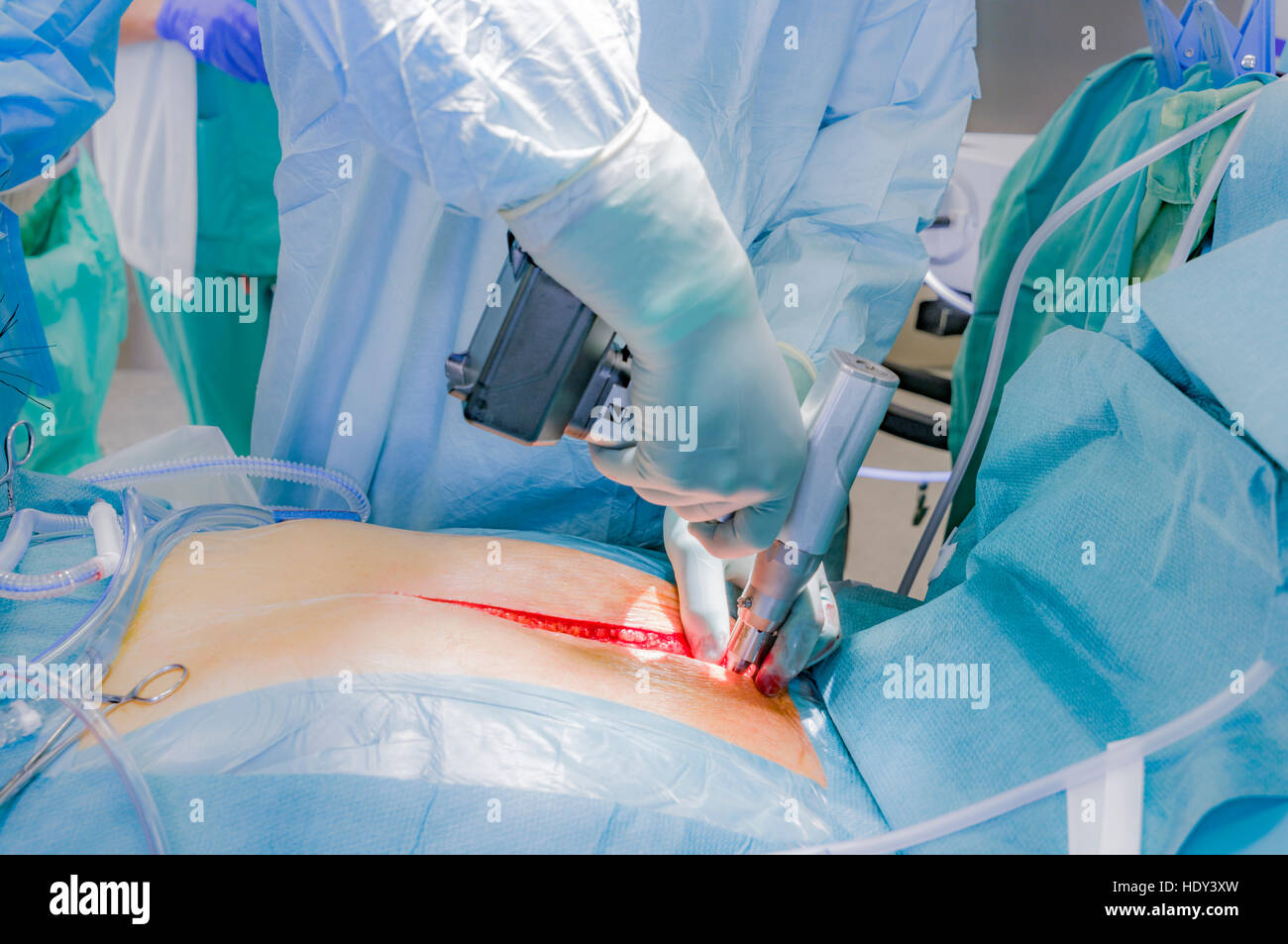À l'aide d'une scie sternale-Cœur de remplacement valvulaire, salle d'opération, Reykjavik, Islande Banque D'Images
