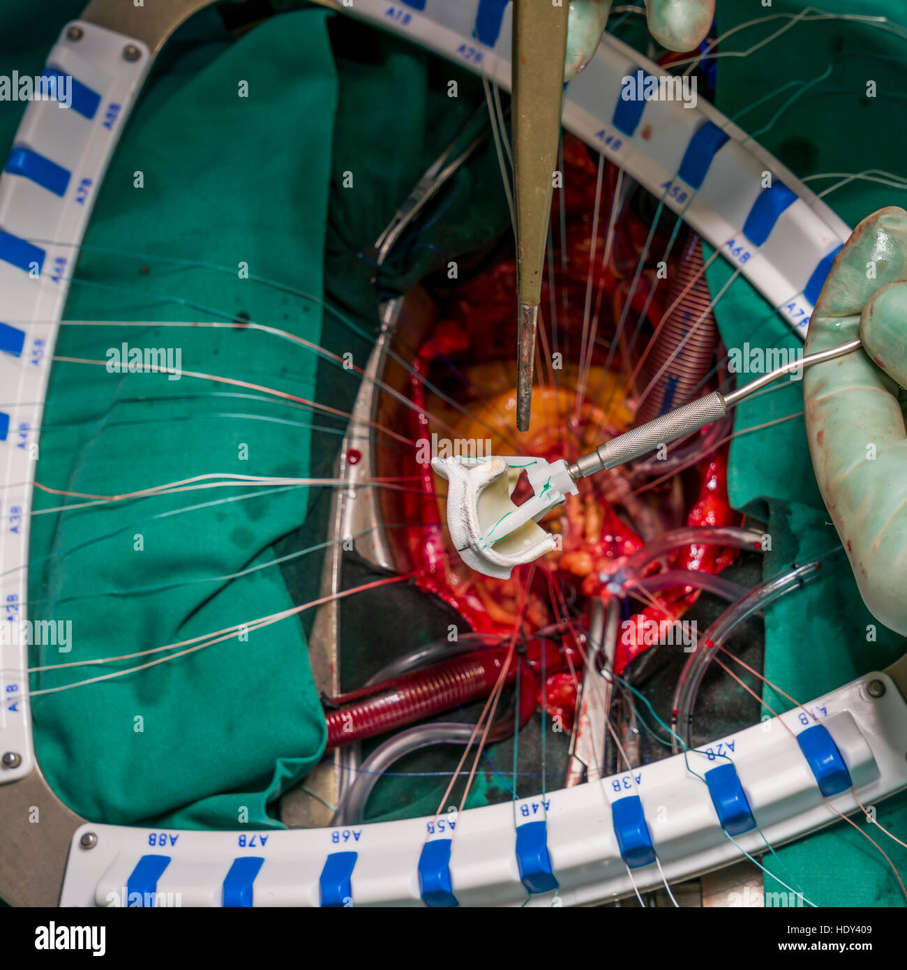 Chirurgie de remplacement de valve cardiaque, salle d'opération, Reykjavik, Islande. Banque D'Images