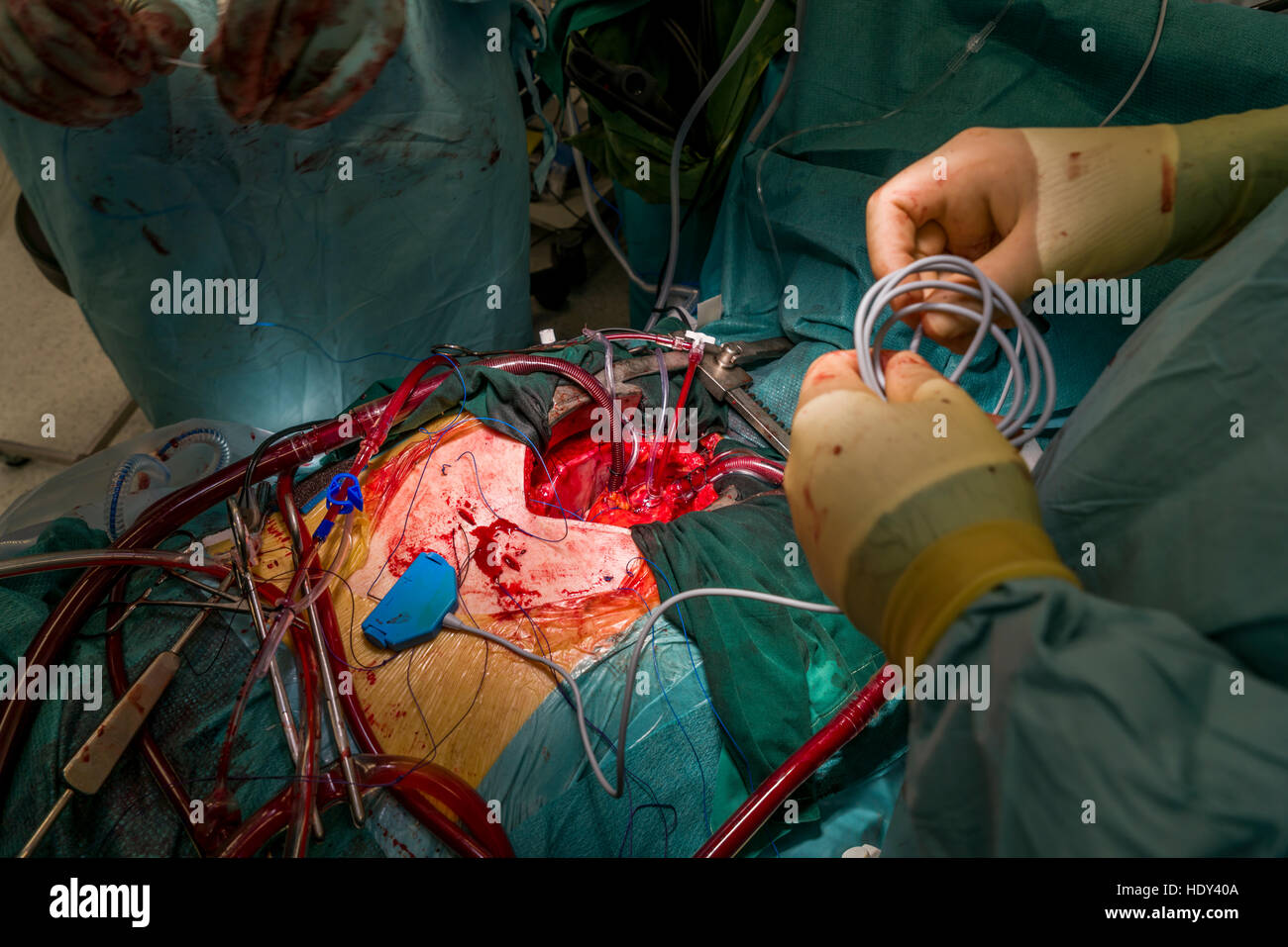 Chirurgie de remplacement de valve cardiaque, salle d'opération, Reykjavik, Islande. Banque D'Images