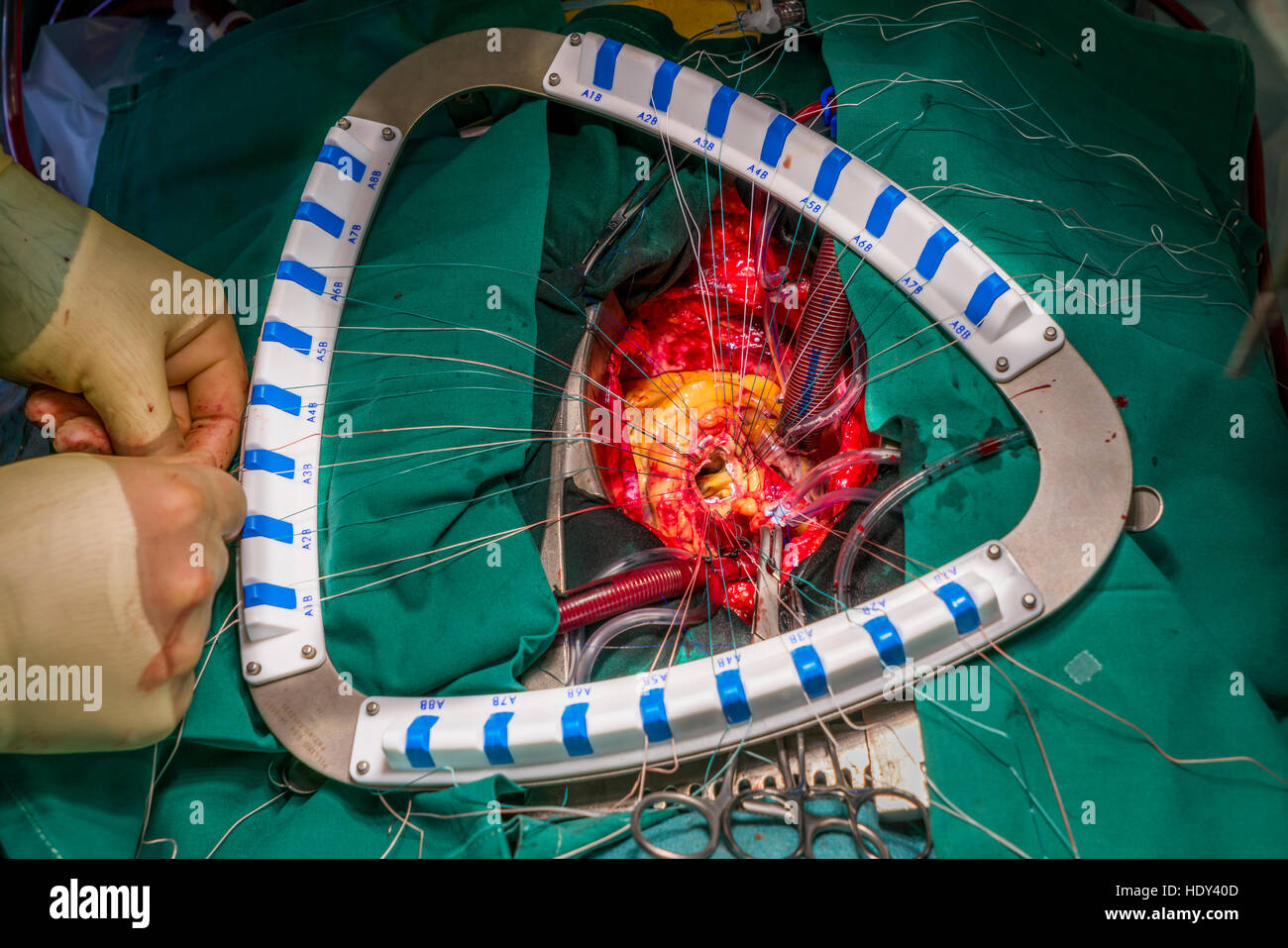 Chirurgie de remplacement de valve cardiaque, salle d'opération, Reykjavik, Islande. Banque D'Images