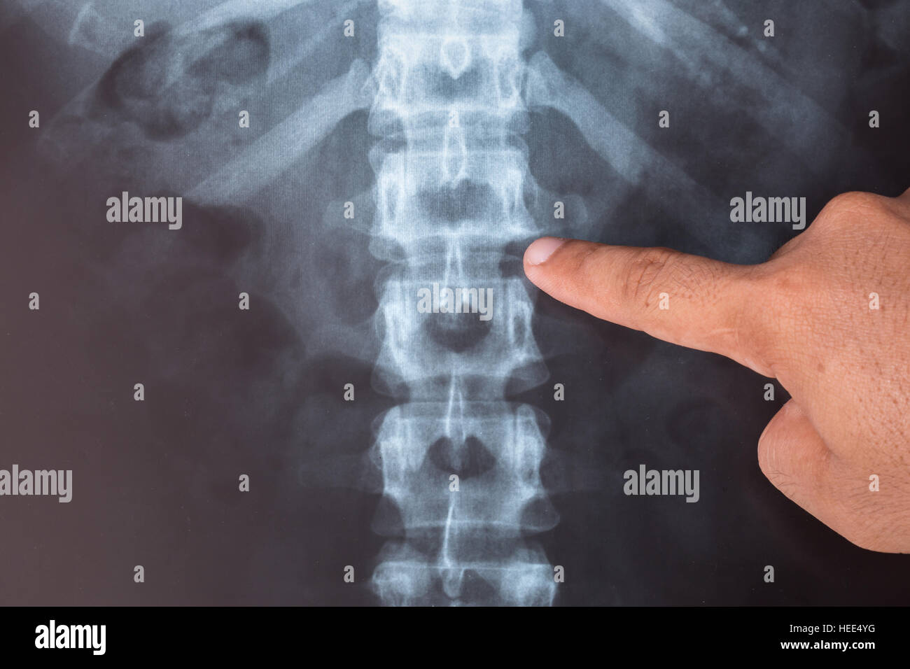 Close up X-ray image d'humain pour un diagnostic médical. Banque D'Images