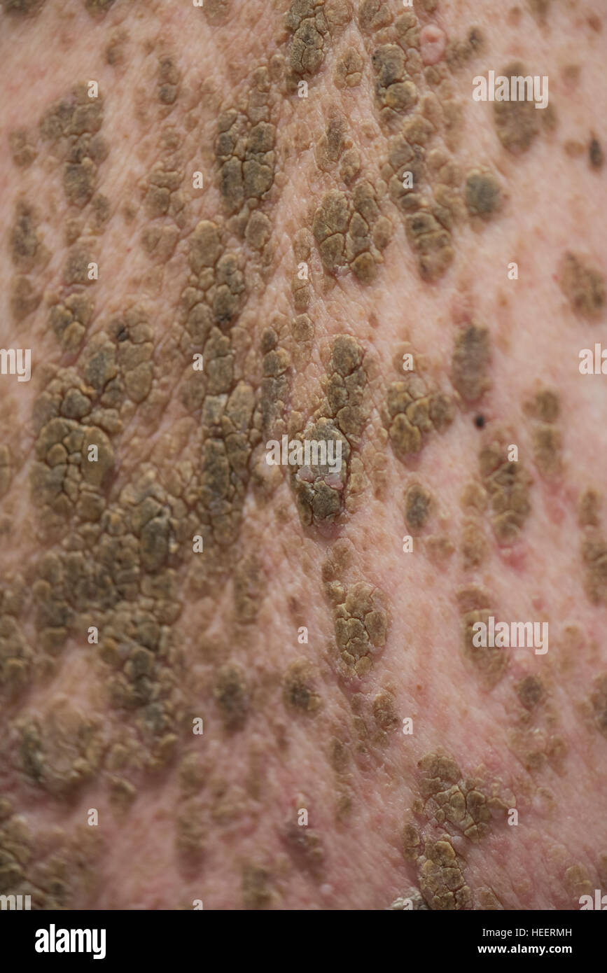 Mans retour à la masse de grains et l'infection Banque D'Images