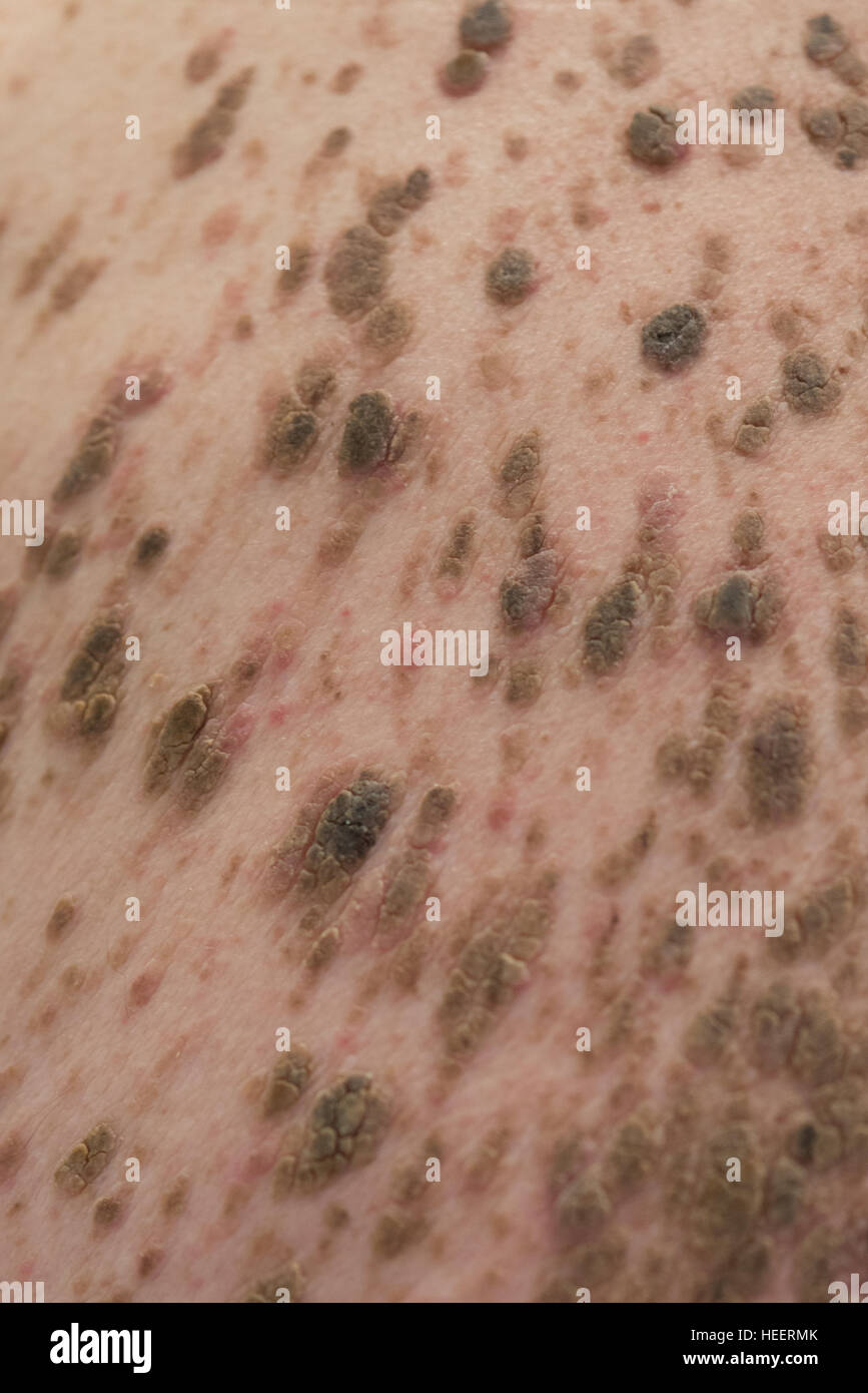 Mans retour à la masse de grains et l'infection Banque D'Images