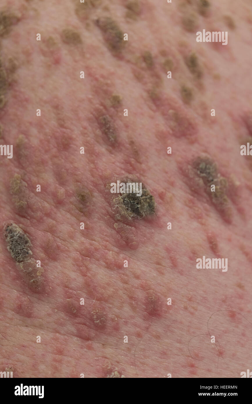 Mans retour à la masse de grains et l'infection Banque D'Images