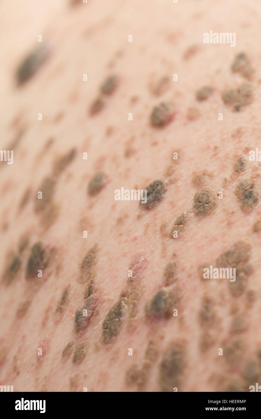 Mans retour à la masse de grains et l'infection Banque D'Images