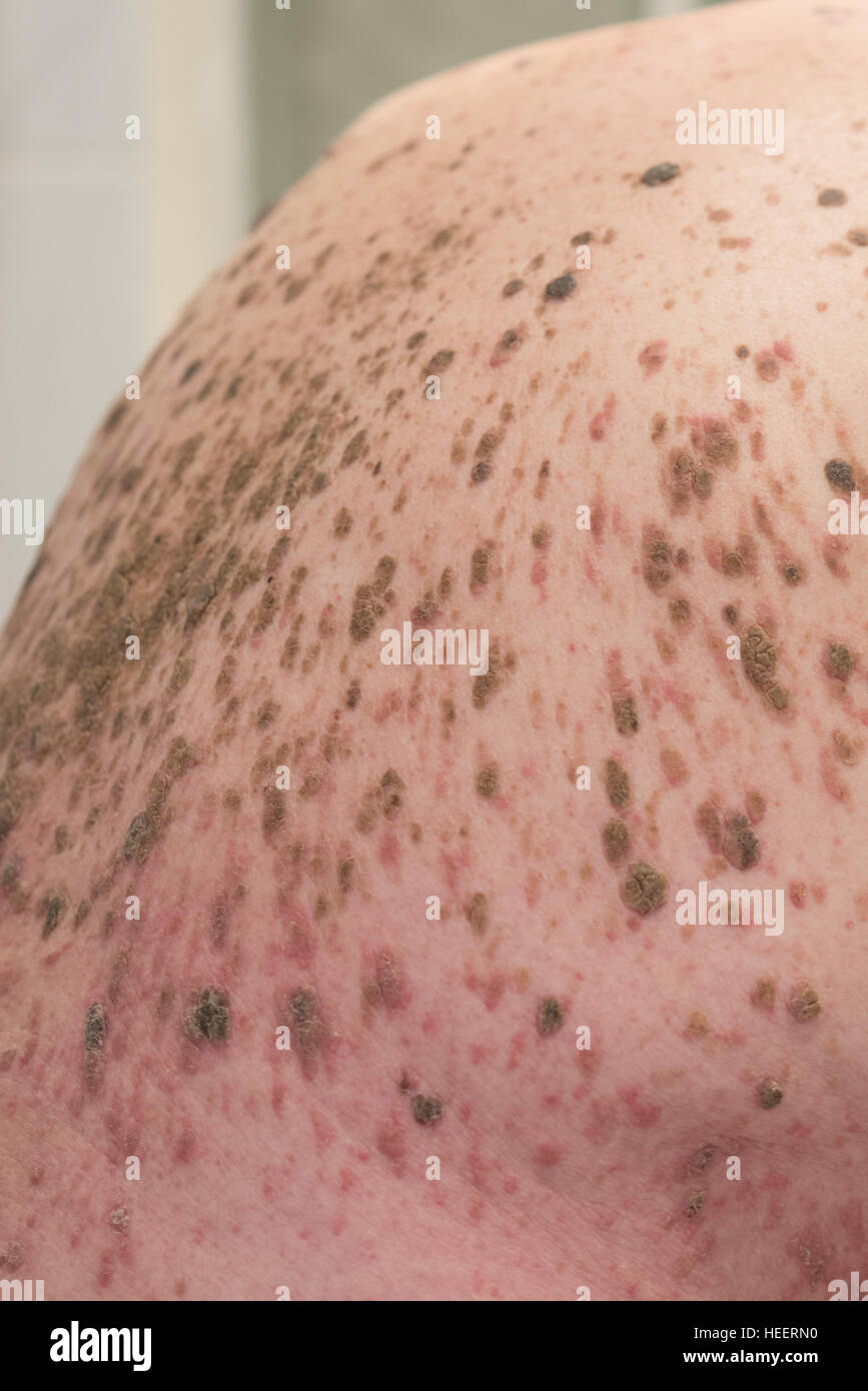 Mans retour à la masse de grains et l'infection Banque D'Images