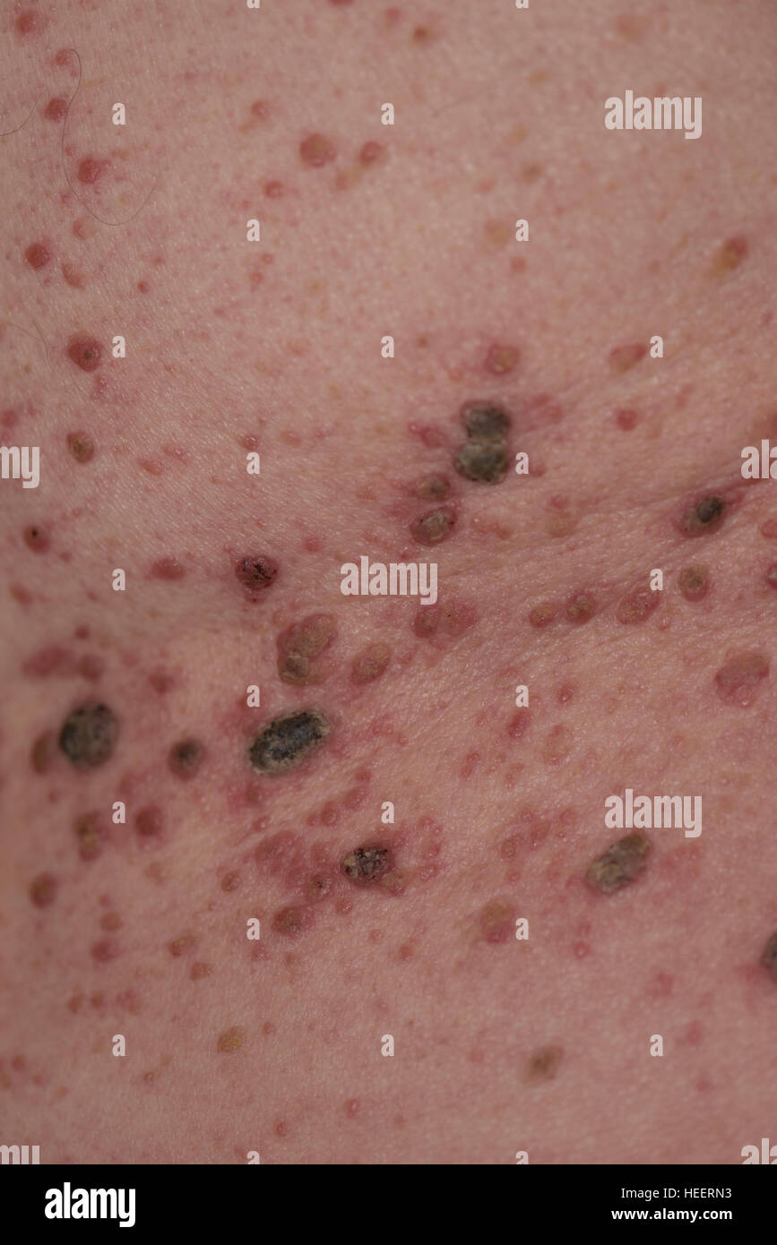 Mans retour à la masse de grains et l'infection Banque D'Images