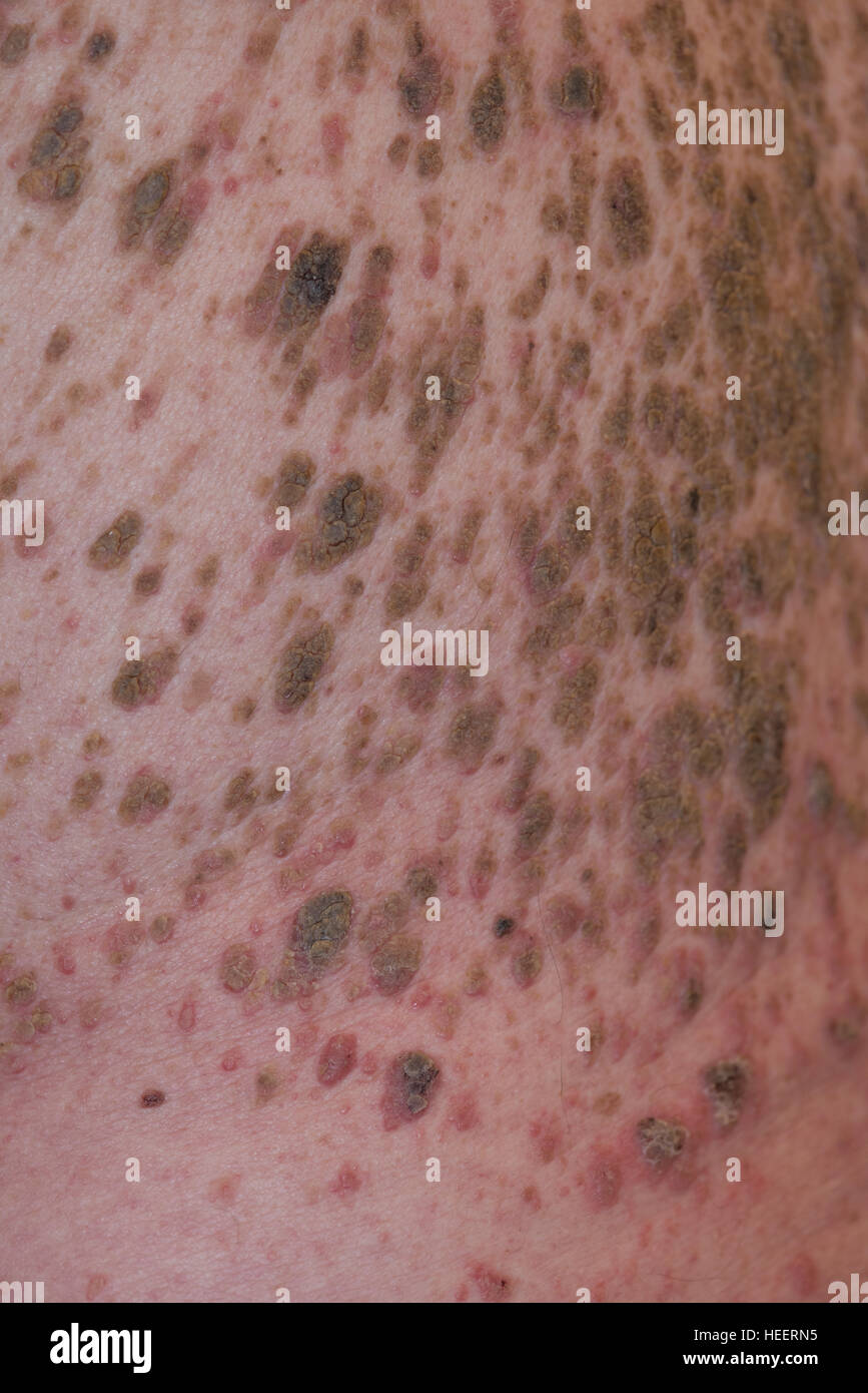 Mans retour à la masse de grains et l'infection Banque D'Images