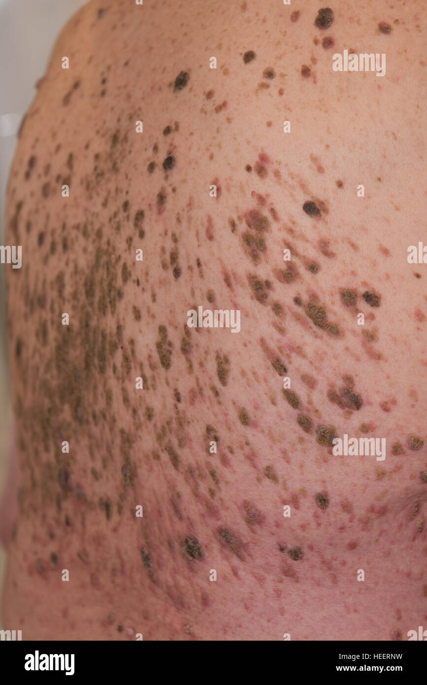 Mans retour à la masse de grains et l'infection Banque D'Images