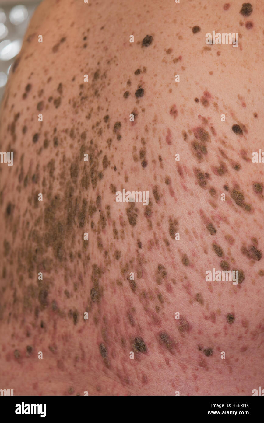 Mans retour à la masse de grains et l'infection Banque D'Images
