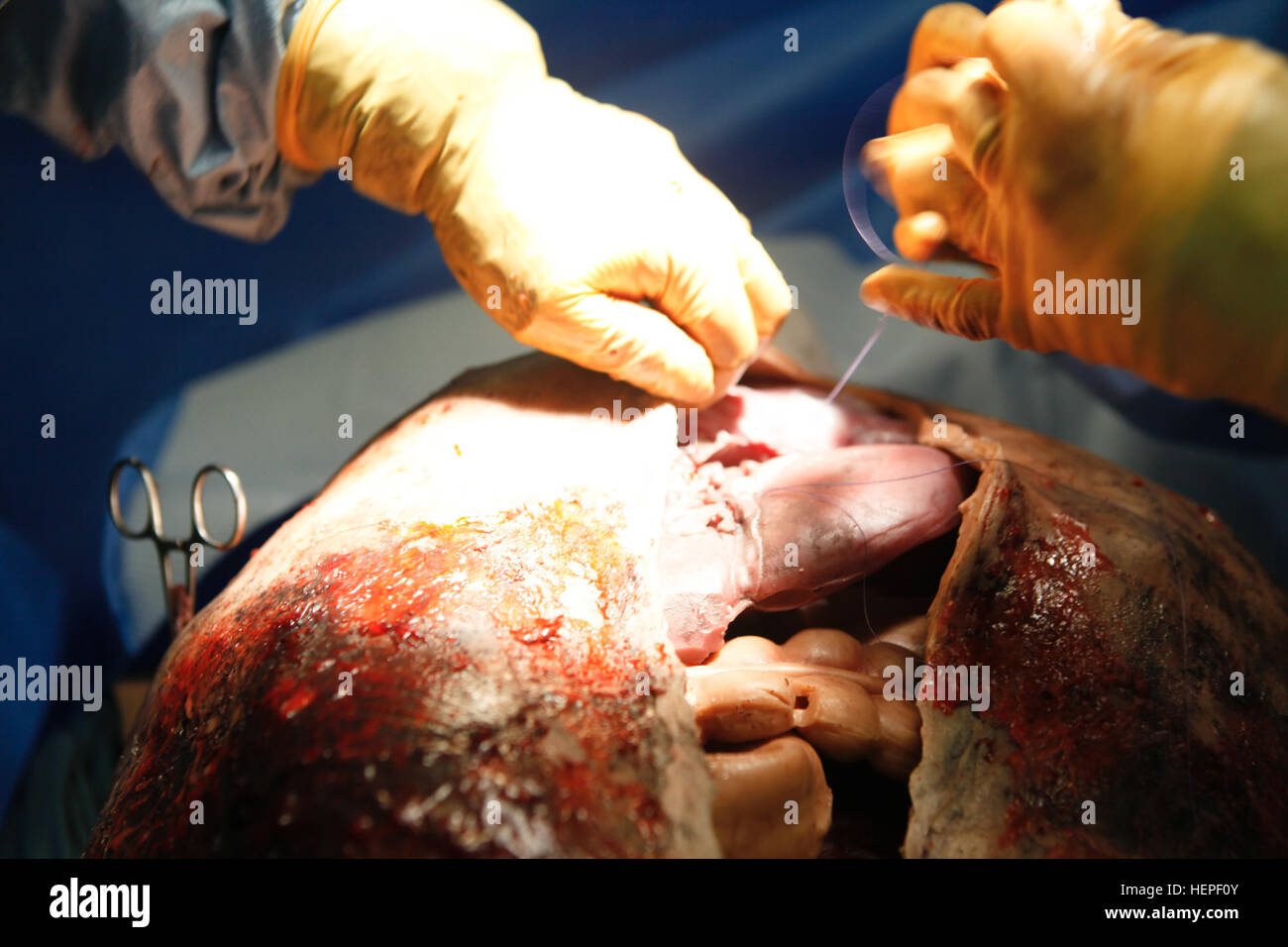 La réserve de la marine américaine le Cmdr. Amy Rohs, droit, et le lieutenant Cmdr. Juan Sanabria, à gauche, à la fois avec le corps expéditionnaire des Grands Lacs un établissement médical, Grands Lacs, Ill., effectuer une simulation de chirurgie sur un costume conçu anatomiquement corrects pour une opération chirurgicale appelée un 'Couper' conviennent au cours de Global Medic à Fort McCoy, au Wisconsin, le 14 juin 2015. Global Medic est le premier événement de formation médicale dans le département de la défense et est le seul exercice accrédités mixte conçu, planifié et exécuté par l'armée de soldats. Les membres en service de plusieurs branches du DoD s'entraînent ensemble à une force conjointe de l'environnement, Banque D'Images