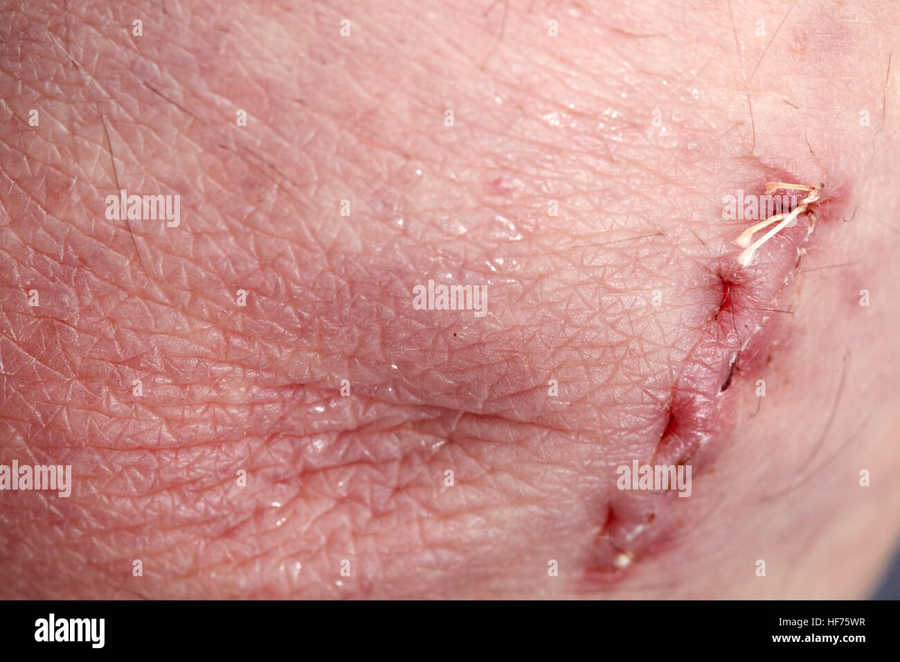 Soluble dans un coude de suture de plaies chirurgicales pour corriger le syndrome du tunnel cubital Banque D'Images