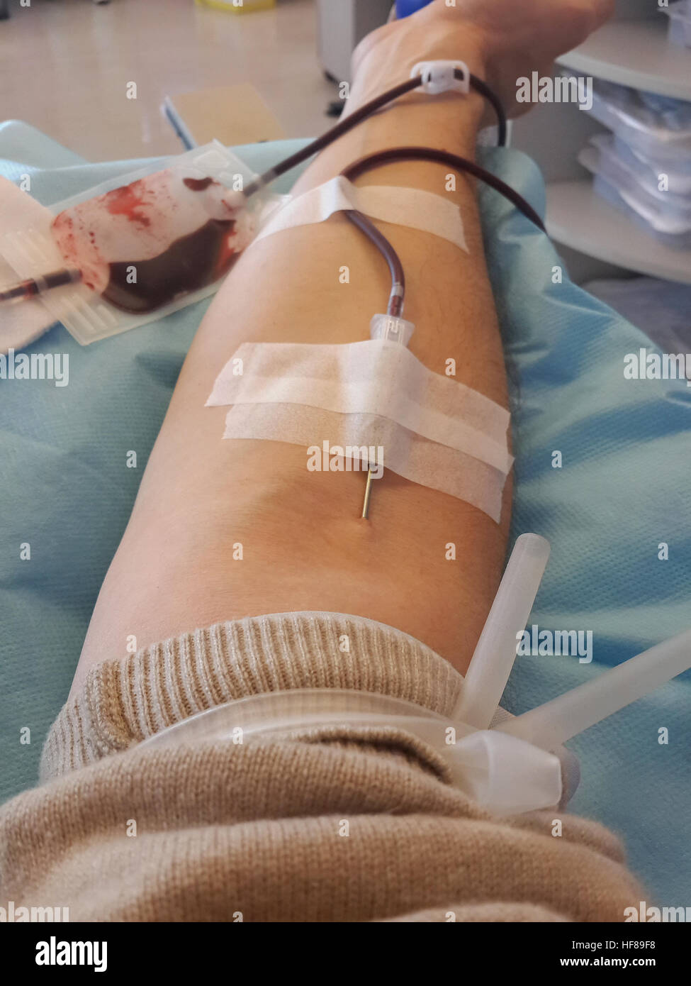 Les jeunes adultes avec l'aiguille au cours de la transfusion sanguine à l'hôpital Banque D'Images