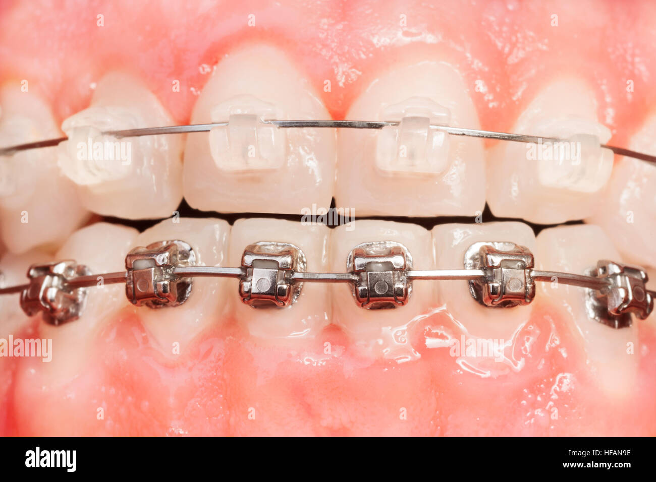 Brackets Orthodontiques Métalliques AZDENT - Pack De 20 - Bases Maille, Traitement Rouge/MBT