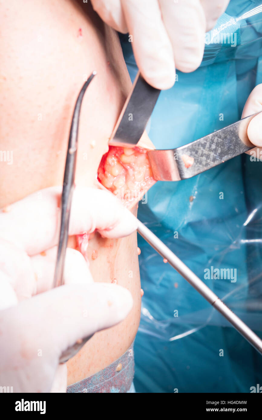 Opération chirurgicale l'arthroscopie du genou chirurgie micro sur les genoux,