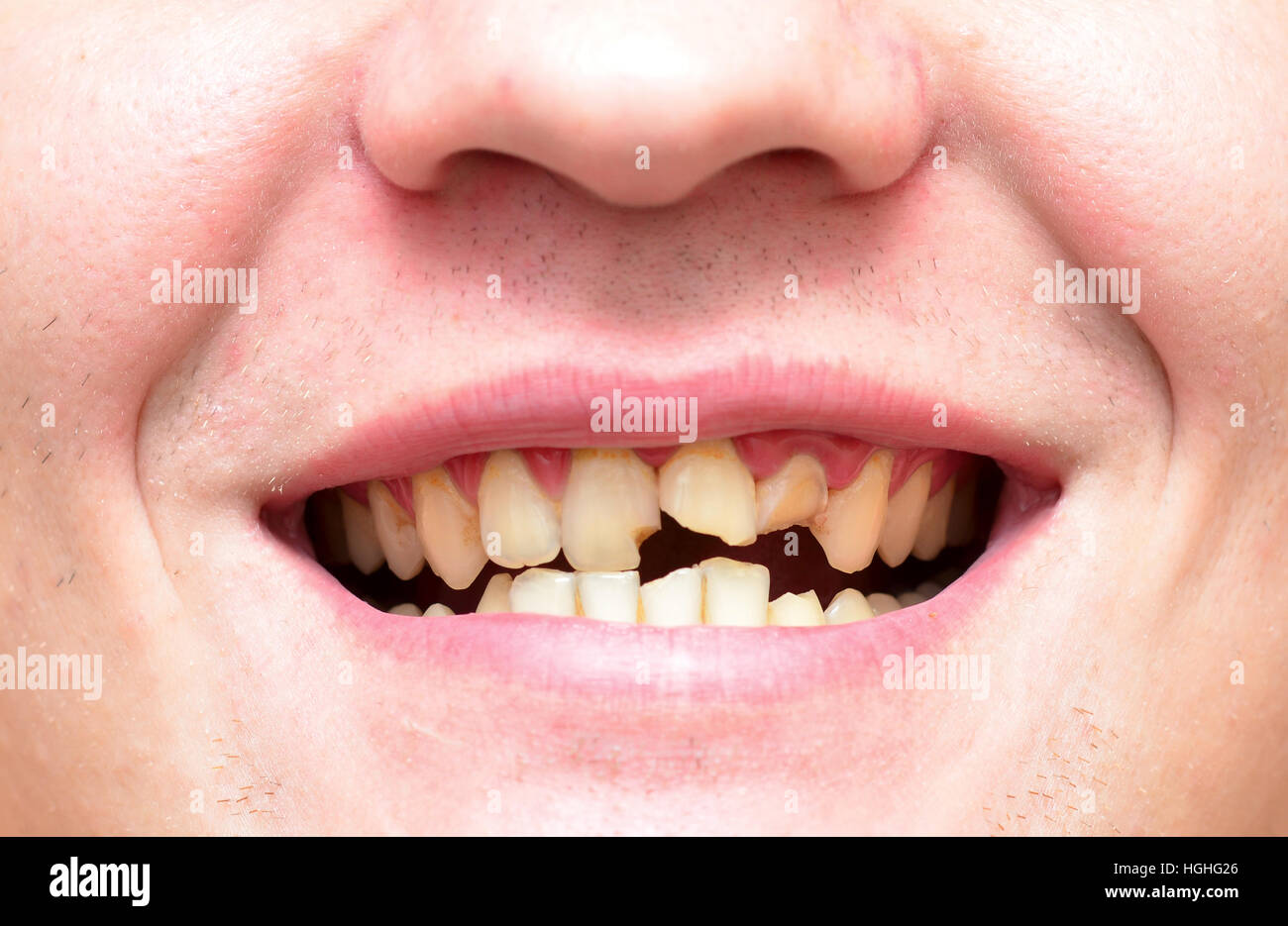 Jeune homme avec une casse les dents pourries et Photo Stock - Alamy