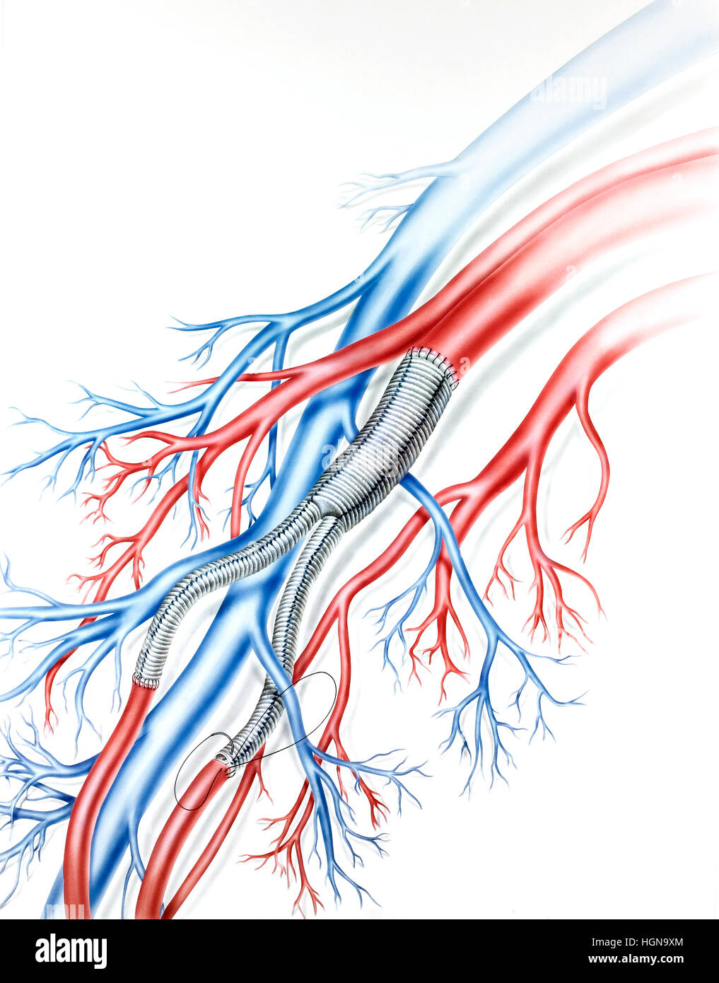 Greffes Teflon vaisseau artériel (gris) dans un poumon humain. Banque D'Images