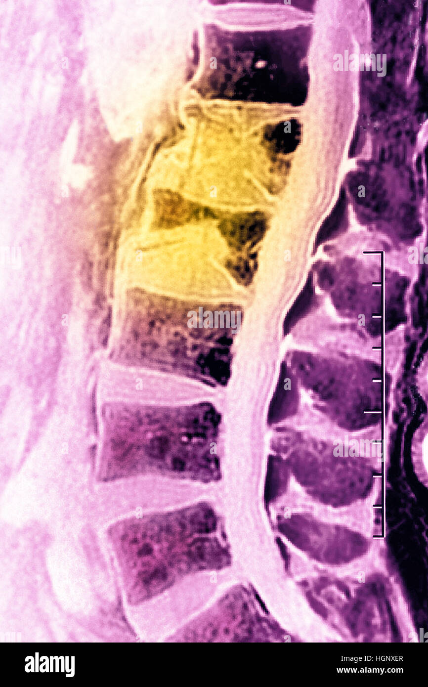 Fracture De Compression Irm Banque d'image