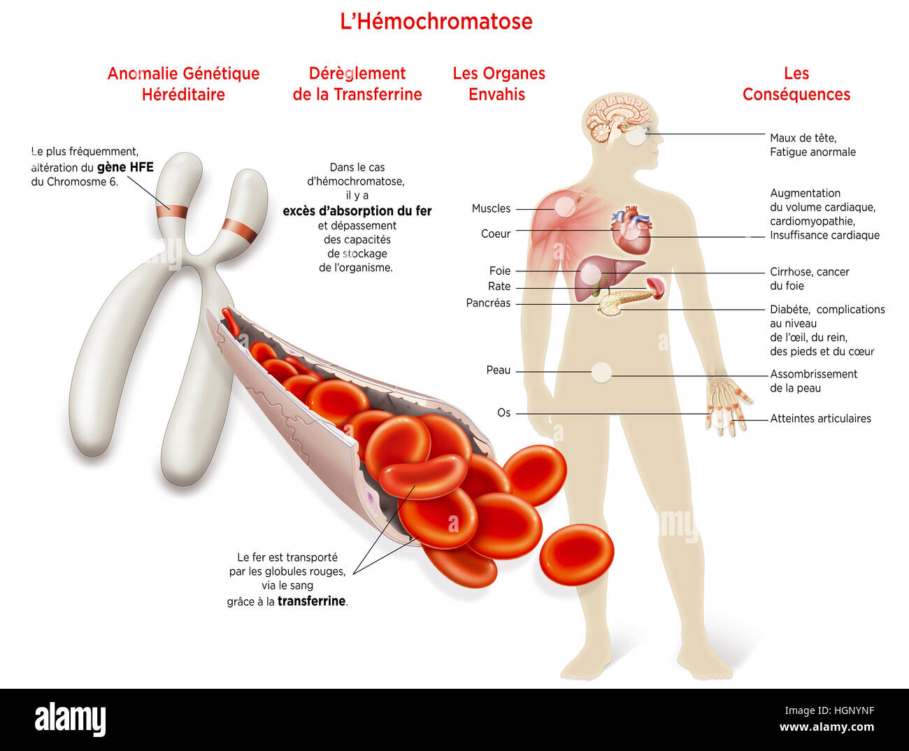 L'hémochromatose, dessin Banque D'Images