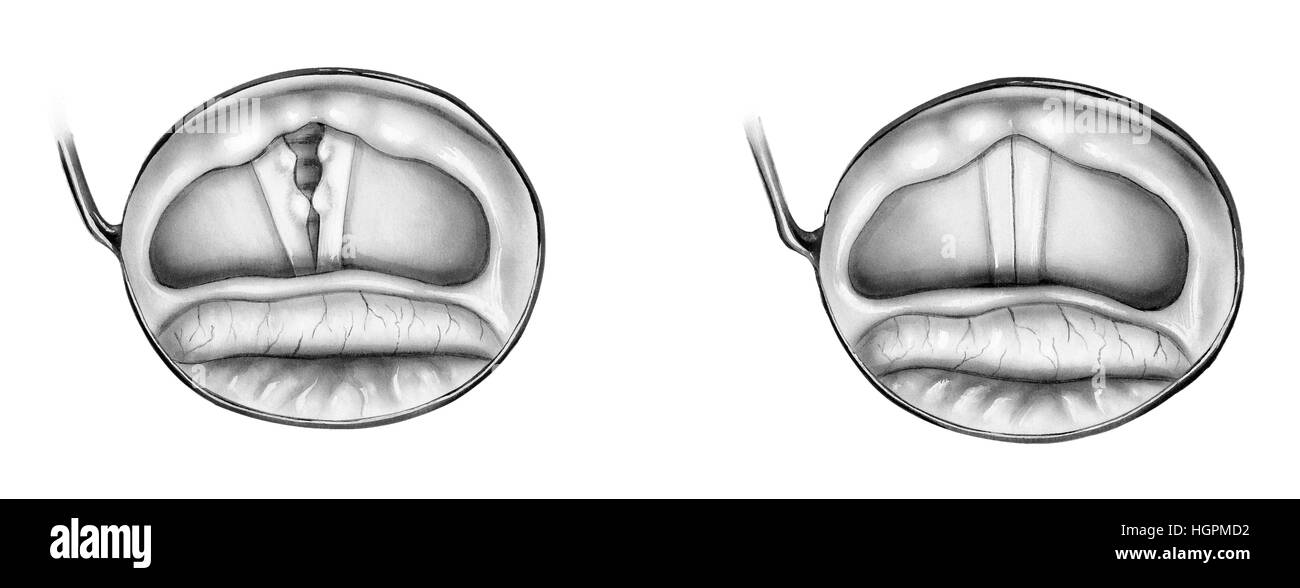 Les droits de l'épiglotte (à gauche) et un abus vocal avec l'épiglotte comme cals nodules (à droite). Indiquées sont la racine de la langue et de la vallecula (a ! Crevic Banque D'Images